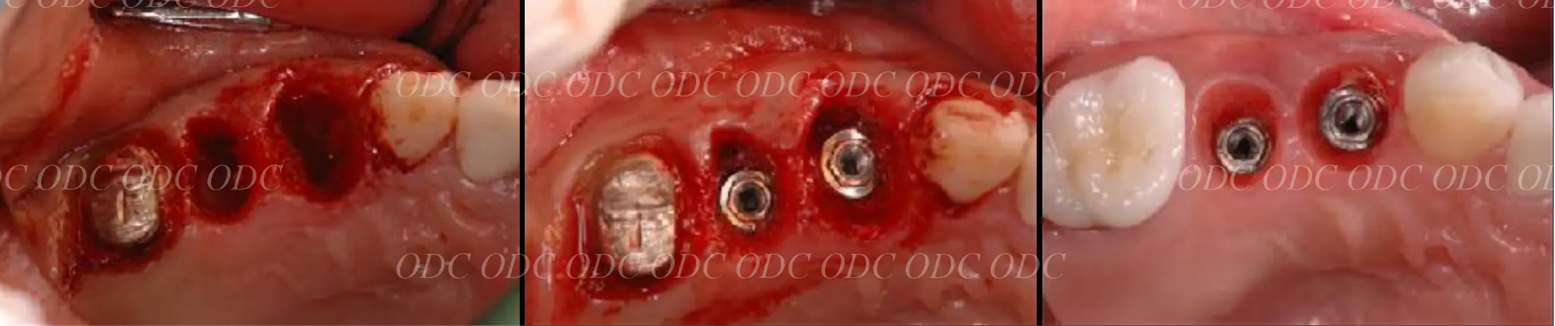 抜歯即時埋入症例