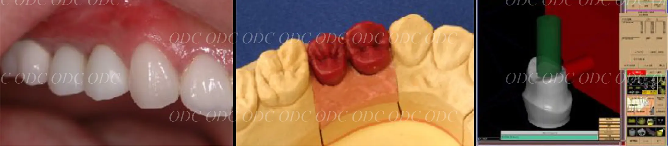 抜歯即時埋入症例