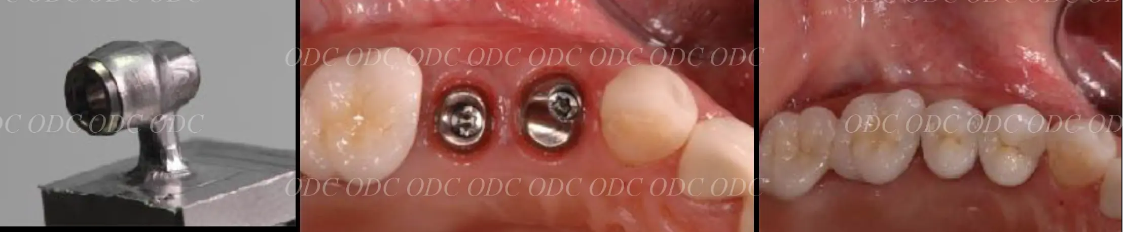 抜歯即時埋入症例