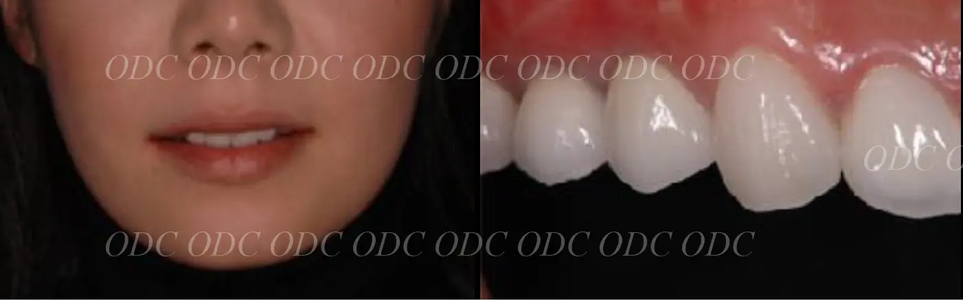 抜歯即時埋入症例