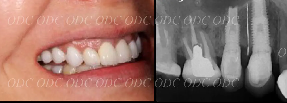 抜歯即時埋入症例