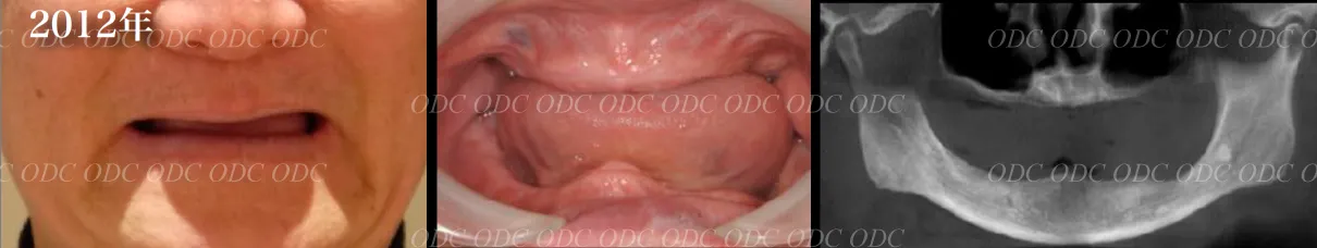 フルマウスリコンストラクション