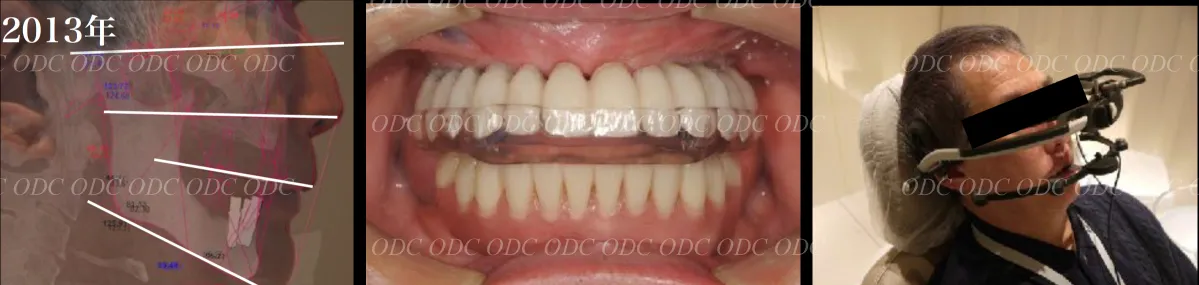 フルマウスリコンストラクション