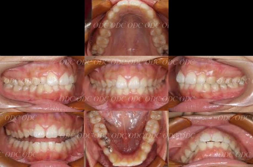 インプラント治療の流れ