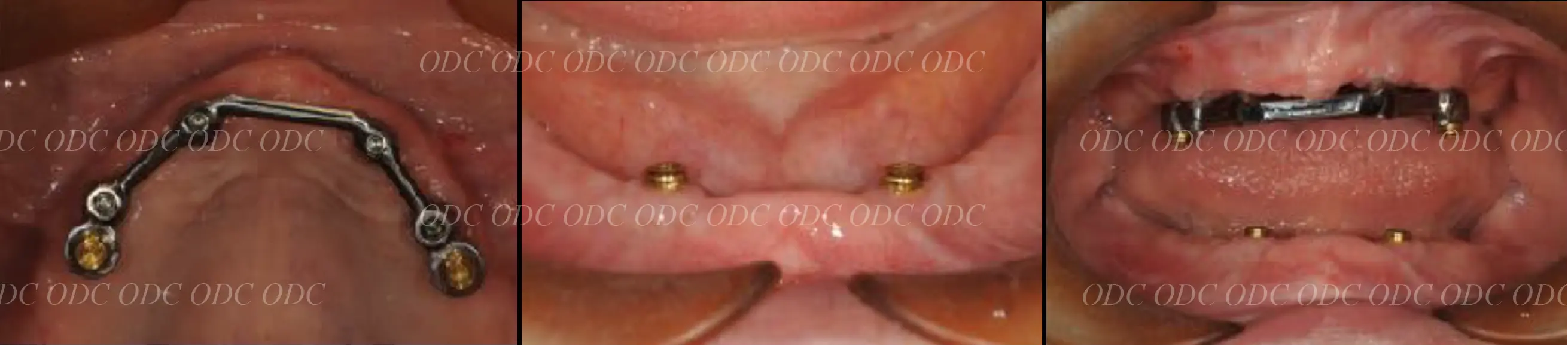 インプラントオーバーデンチャー