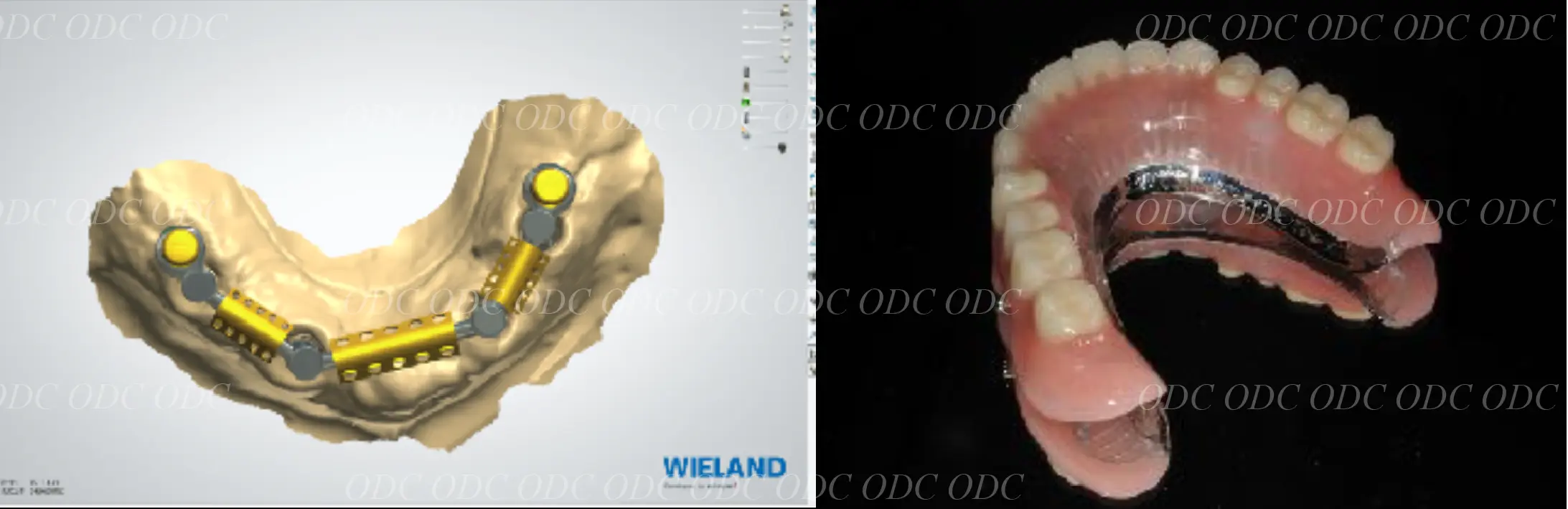 インプラントオーバーデンチャー