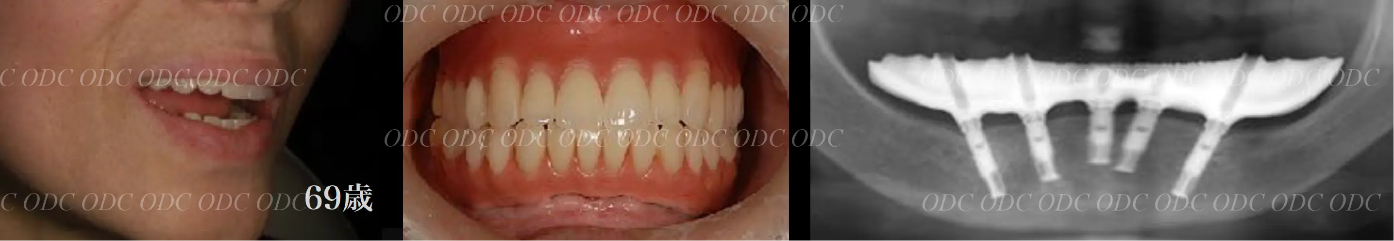 インプラント補綴（上部構造）