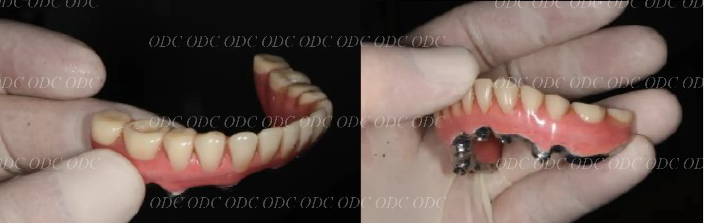 インプラント補綴（上部構造）