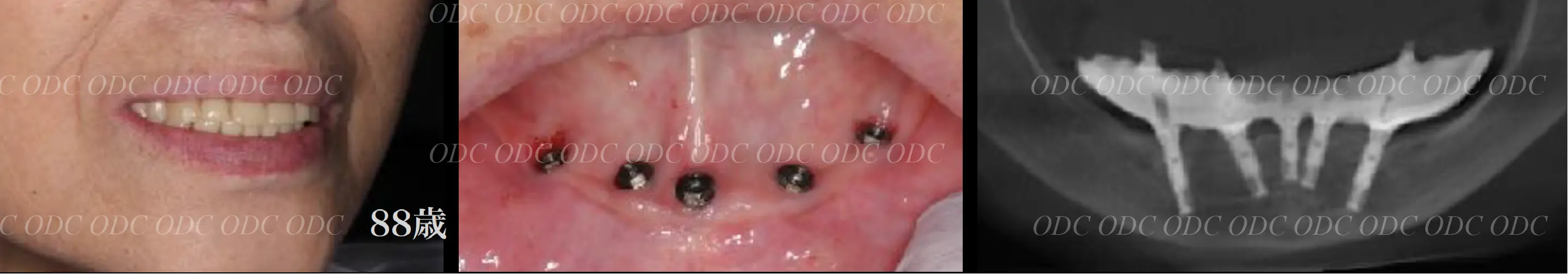 インプラント補綴（上部構造）