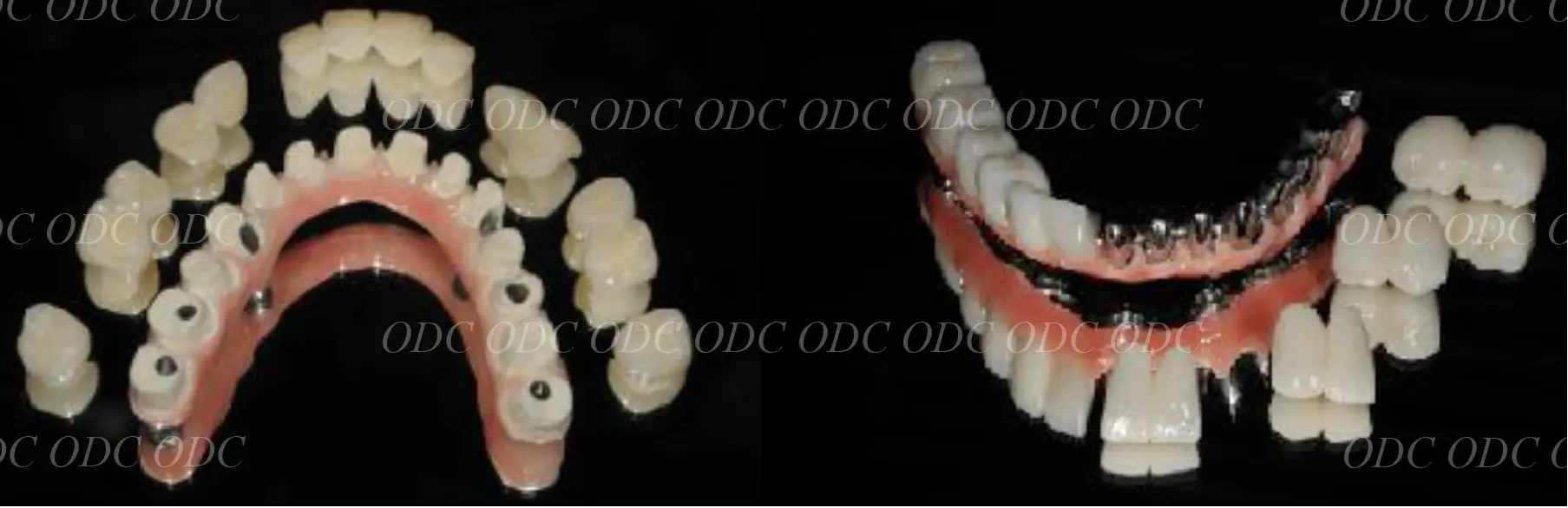 インプラント補綴（上部構造）