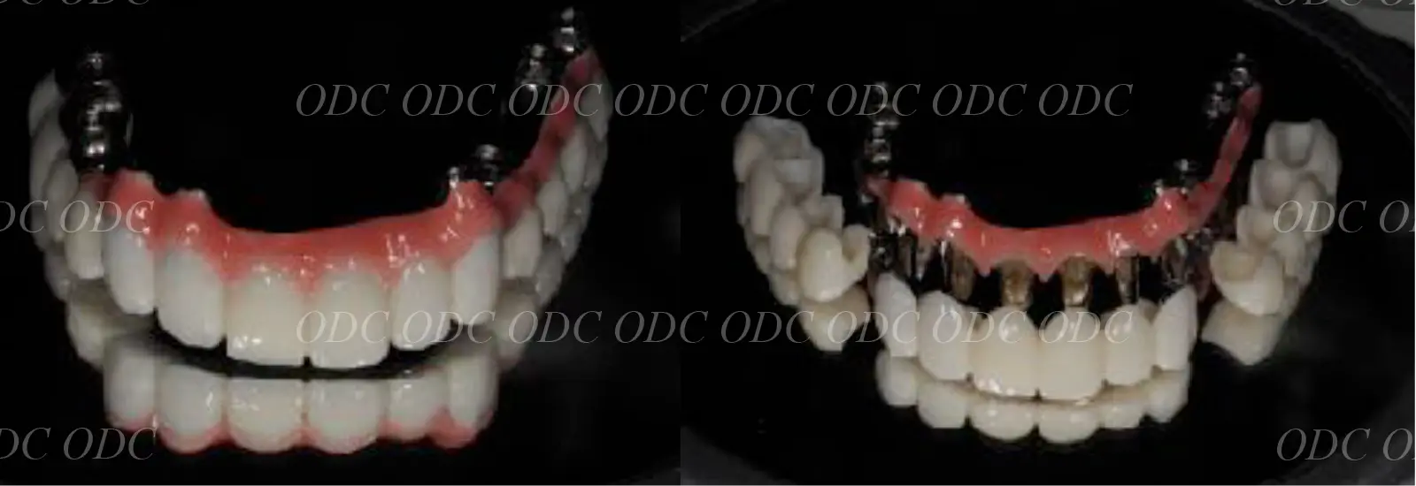 インプラント補綴（上部構造）