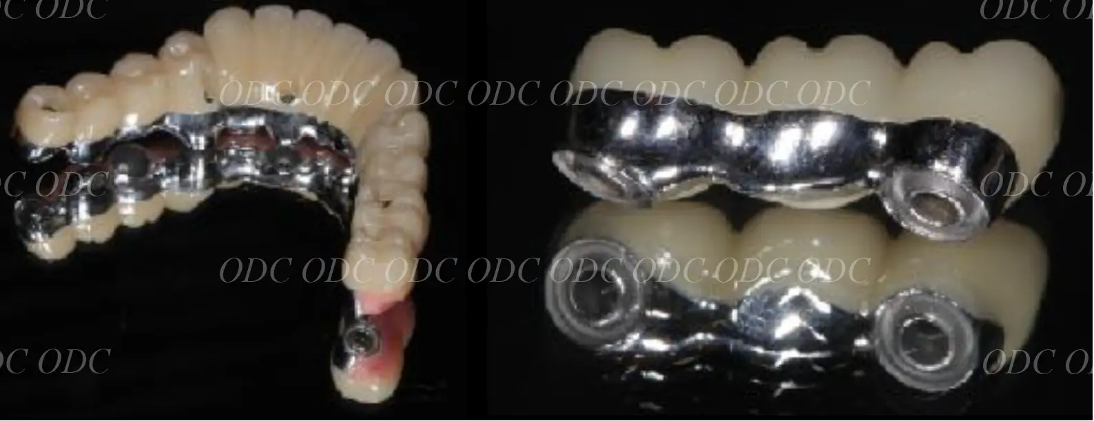 インプラント補綴（上部構造）