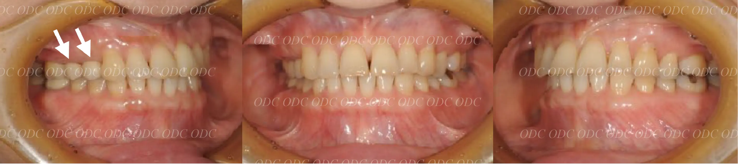 インプラント補綴（上部構造）