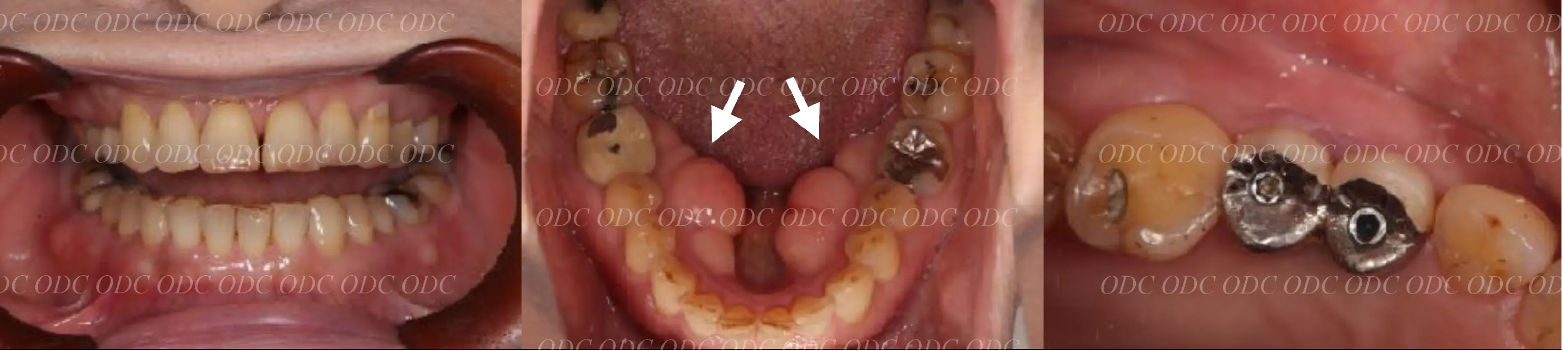 インプラント補綴（上部構造）