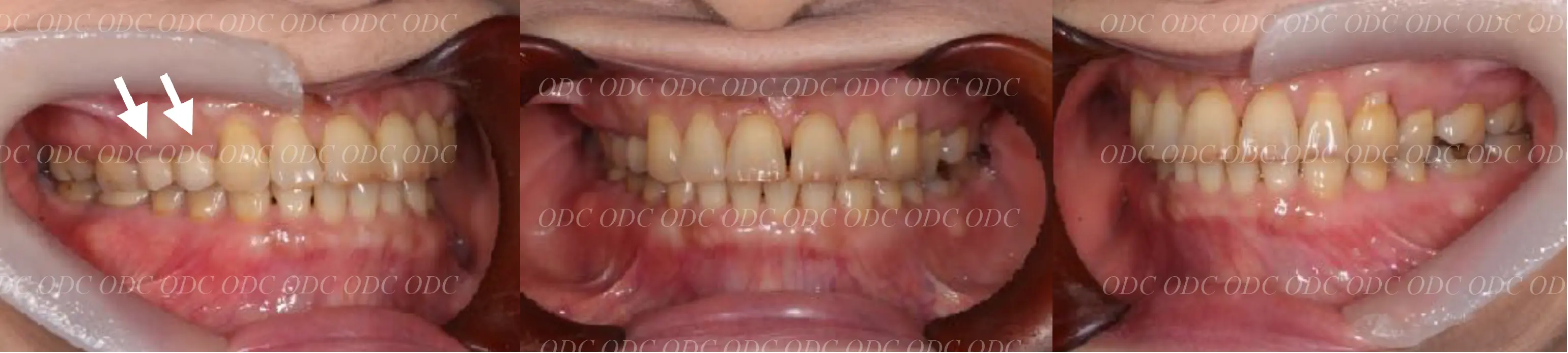 インプラント補綴（上部構造）