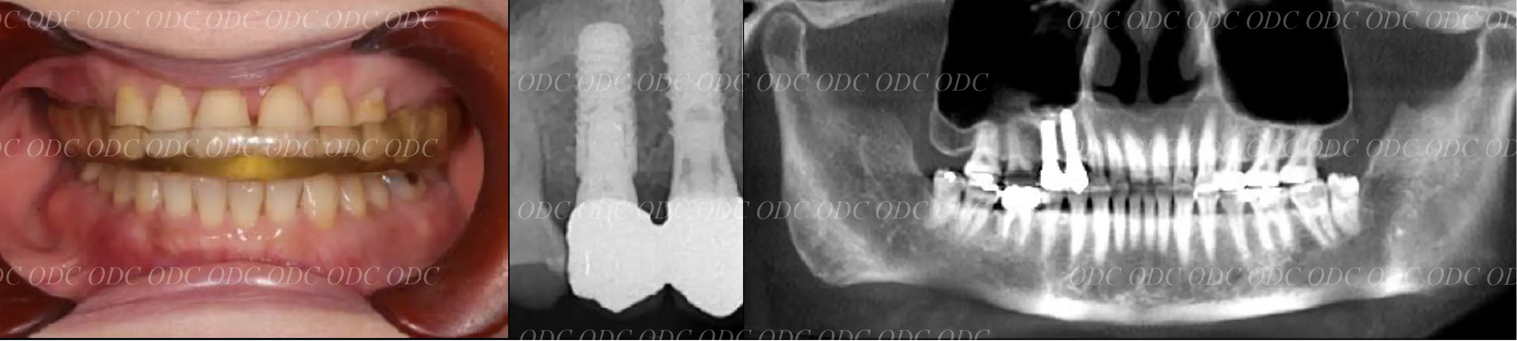 インプラント補綴（上部構造）