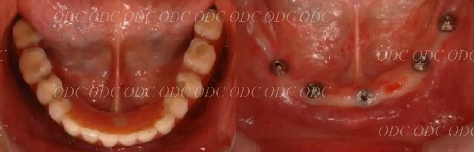 インプラント補綴（上部構造）