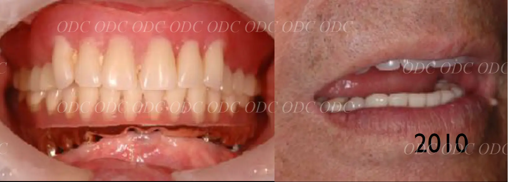 インプラント補綴（上部構造）