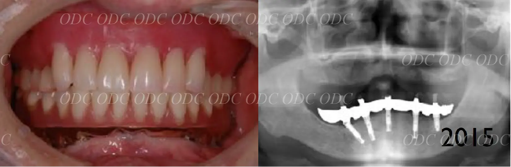 インプラント補綴（上部構造）