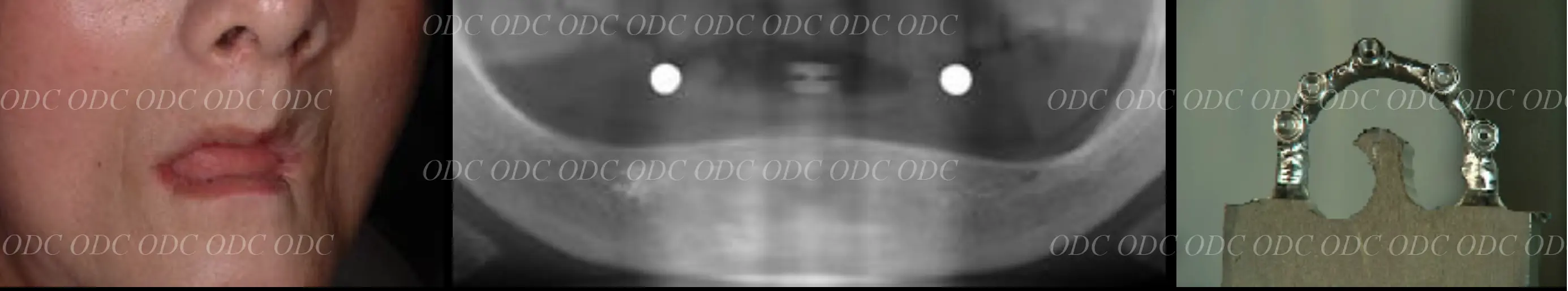 インプラント補綴（上部構造）