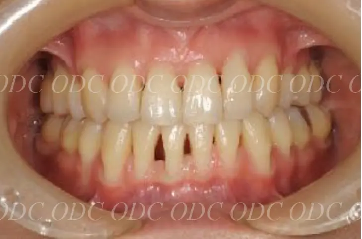 噛み合わせのズレ