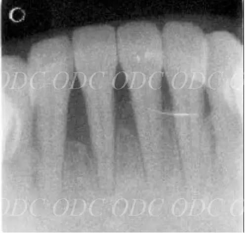 噛み合わせのズレ
