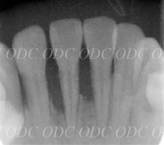 噛み合わせのズレ