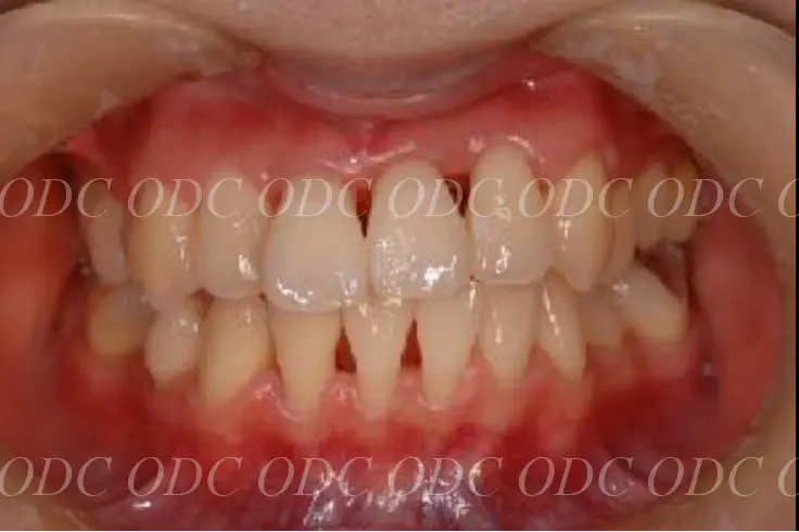 噛み合わせのズレ