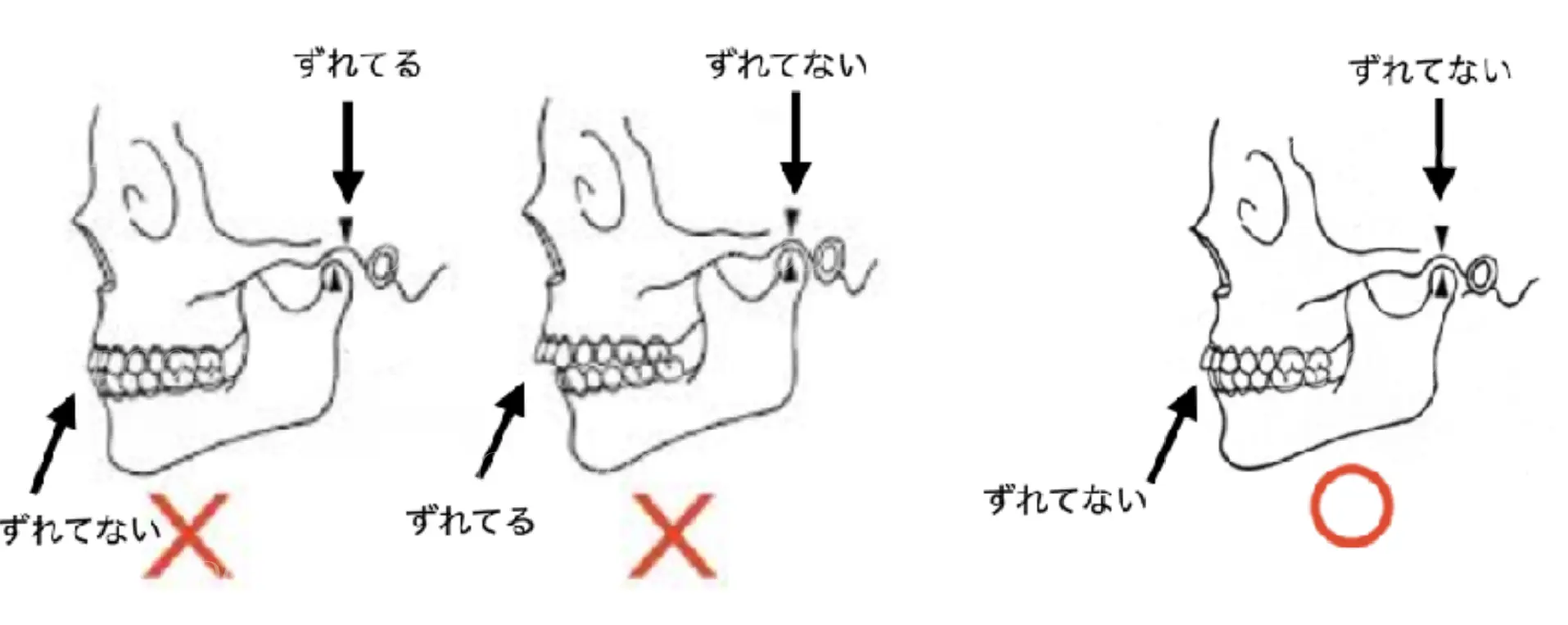 噛み合わせのズレ