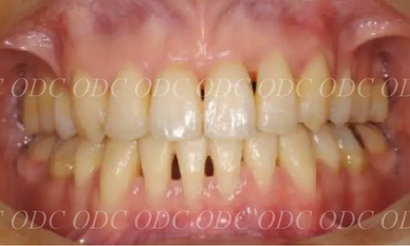 噛み合わせのズレ