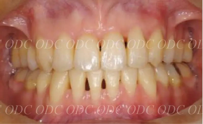 噛み合わせのズレ