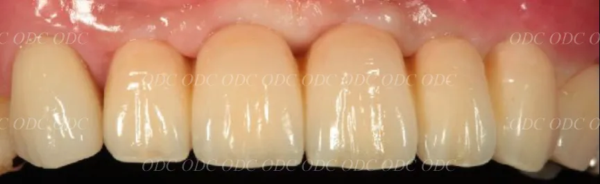 前歯部　多数歯欠損症例