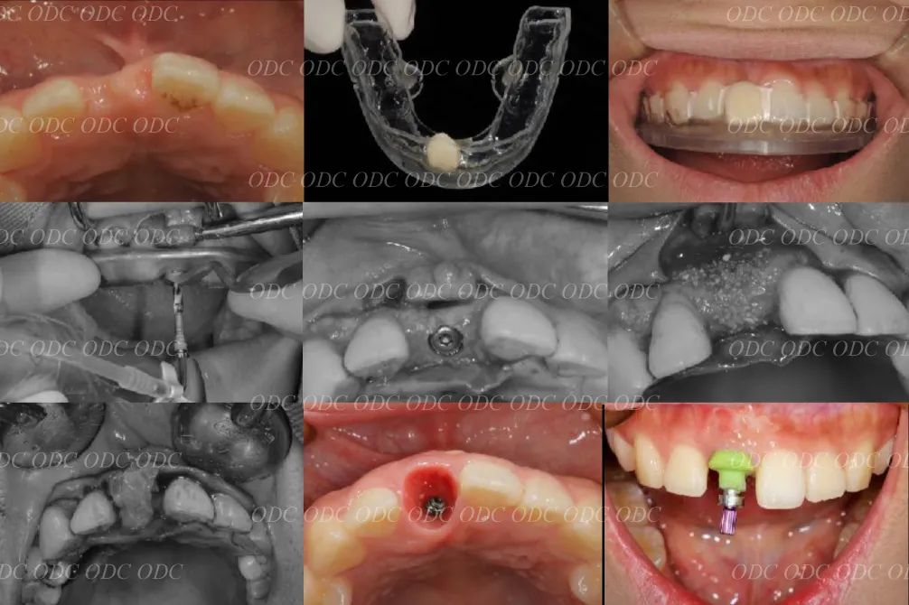 前歯部　少数歯欠損症例
