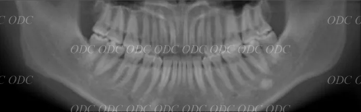 前歯部　少数歯欠損症例