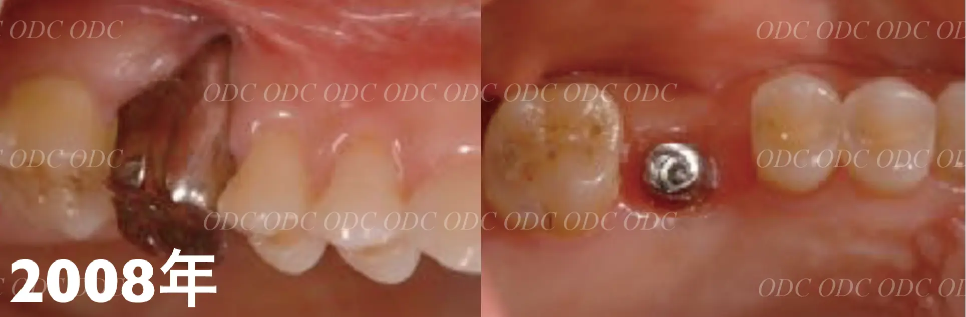 サイナスリフト