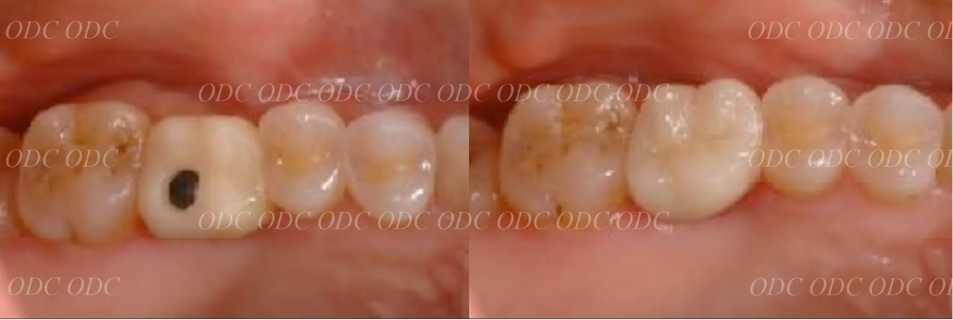 サイナスリフト