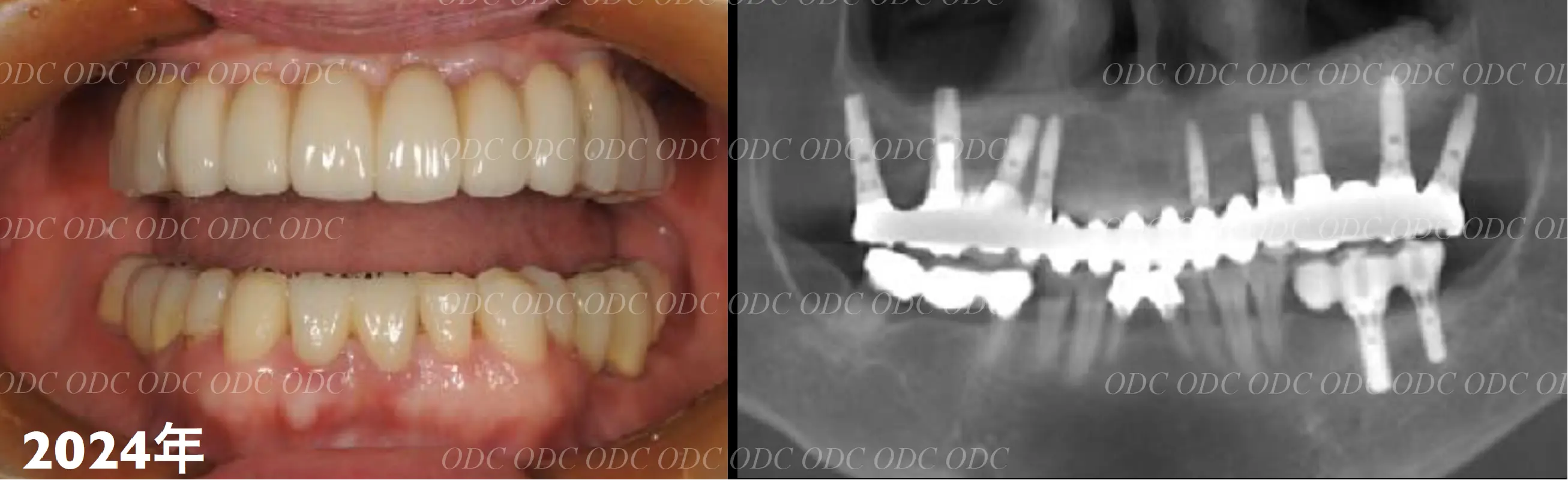 サイナスリフト