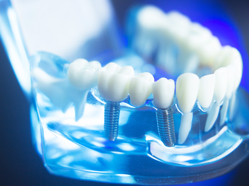 インプラント治療の流れ