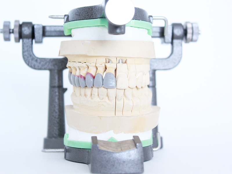 かみ合わせ不良(ズレ)