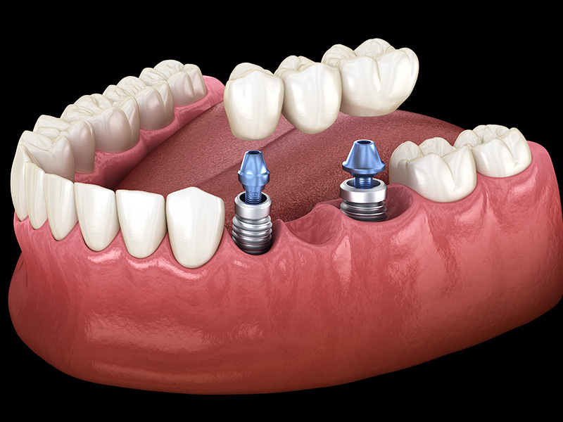 抜歯即時インプラント