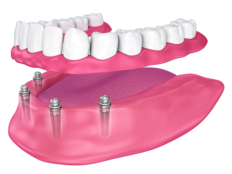 インプラントオーバーデンチャー