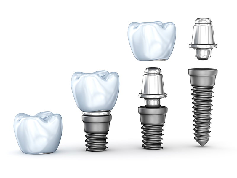 インプラント補綴(上部構造)